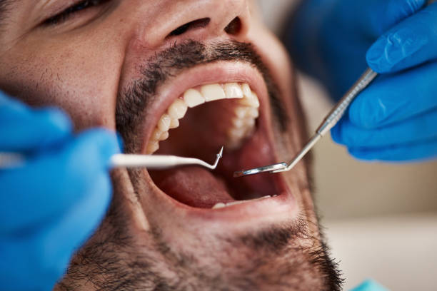 Best Emergency Dental Extractions in Charter Oak, CA